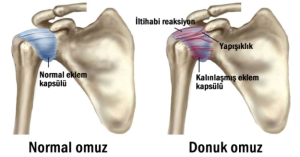 malatya evde fizik tedavi, donuk omuz tedavisi, malatya en iyi fizyoterapist