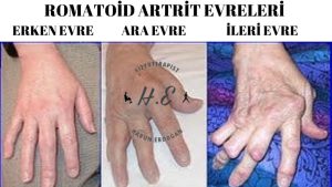 malatyaevdefiziktedavi,romatoidartrit