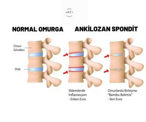 malatyaevdefiziktedavi,ankilozanspondilit